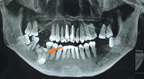 Răng sinh ba - Dị dạng răng hiếm gặp - Ảnh 1.