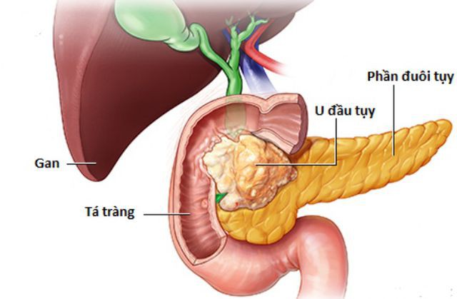 Dấu hiệu cảnh báo bệnh ung thư tụy - Ảnh 1.