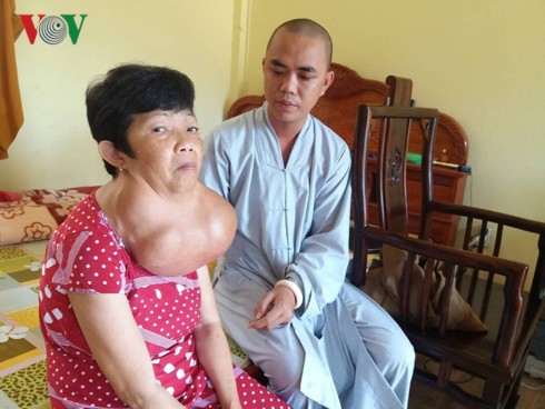 Người phụ nữ 35 năm mang khối bướu gần 10kg trên cổ - Ảnh 1. Người phụ nữ 35 năm mang khối bướu gần 10kg trên cổ - Ảnh 1.