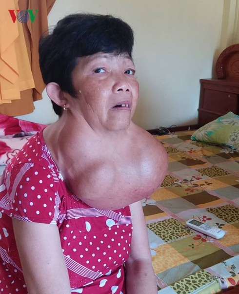 Người phụ nữ 35 năm mang khối bướu gần 10kg trên cổ - Ảnh 2. Người phụ nữ 35 năm mang khối bướu gần 10kg trên cổ - Ảnh 2.