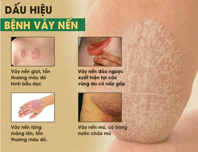 Bệnh vảy nến và cách điều trị hiệu quả, ngăn tái phát - Ảnh 1.