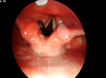 Đỉa rừng dài 5cm sống bám trong khí quản người đàn ông suốt 1 tháng - Ảnh 1.