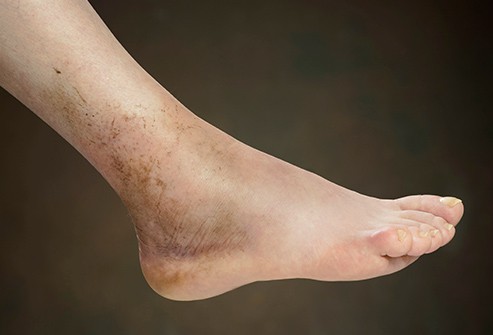 Những nguyên nhân khiến bàn chân bị sưng tấy - Ảnh 2.