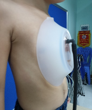 Đặt chu&ocirc;ng n&acirc;ng xương ức: Th&ecirc;m sự lựa chọn điều trị cho bệnh nhi l&otilde;m ức bẩm sinh - Ảnh 2.