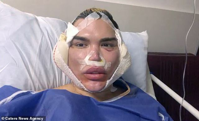 Gương mặt sưng phồng đáng sợ của Rodrigo Alves sau ca “dao kéo” - Ảnh 1.