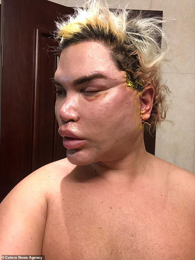 Gương mặt sưng phồng đáng sợ của Rodrigo Alves sau ca “dao kéo” - Ảnh 2.