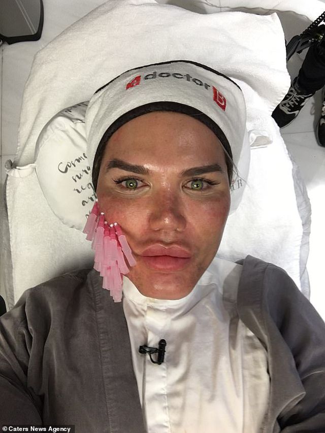Gương mặt sưng phồng đáng sợ của Rodrigo Alves sau ca “dao kéo” - Ảnh 3.
