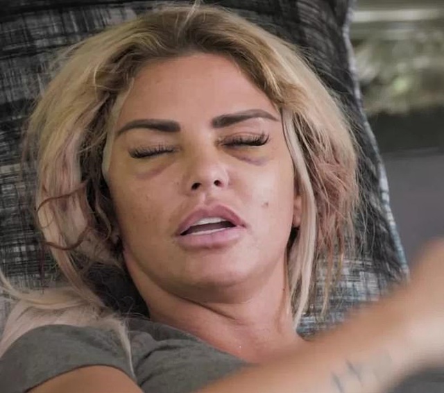 Katie Price tiếp tục làm đẹp bằng dao kéo - Ảnh 1. Katie Price tiếp tục làm đẹp bằng dao kéo - Ảnh 1.