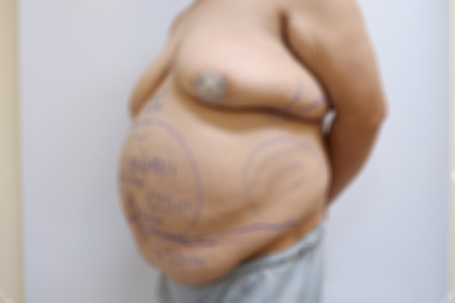Tạo hình thành bụng cho người phụ nữ có cân nặng 115kg - Ảnh 1. Tạo hình thành bụng cho người phụ nữ có cân nặng 115kg - Ảnh 1.