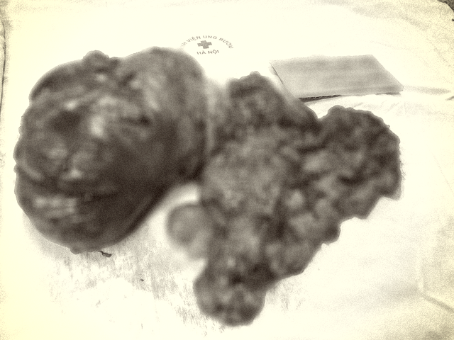 T&aacute;i ph&aacute;t khối ung thư k&iacute;ch cỡ lớn lần 2 - Ảnh 1.