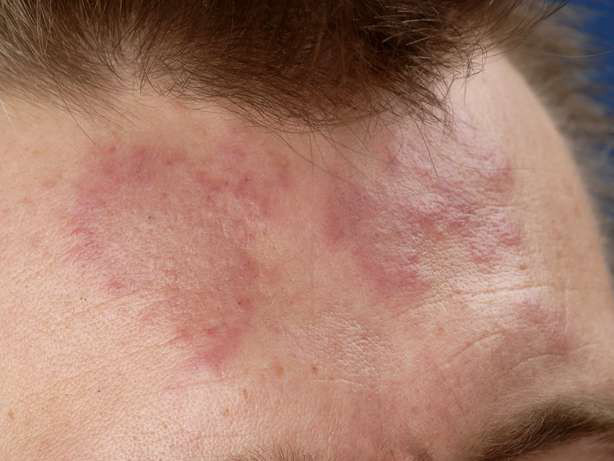 10 triệu chứng của bệnh lupus ban đỏ  - Ảnh 5.