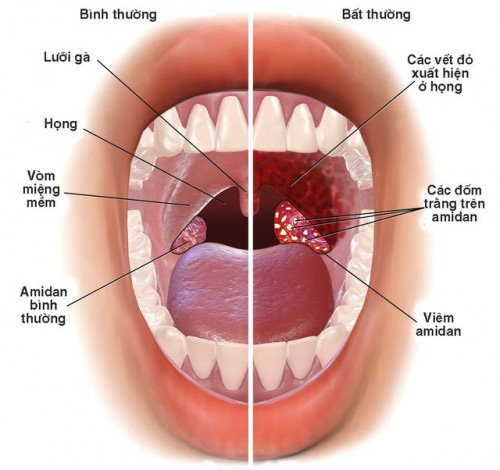 Thực phẩm bảo vệ sức khỏe Vương Phế An - giải pháp giúp hỗ trợ giảm ho rát do viêm đường hô hấp trên - Ảnh 1.