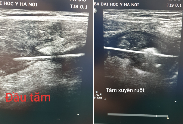 Hy hữu: Nuốt phải tăm... sau 2 tuần được lấy ra qua thành bụng - Ảnh 1.