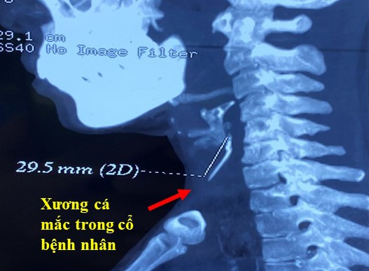 Vừa ăn vừa trả lời điện thoại, mảnh xương cá găm vào cổ họng suốt 3 tháng - Ảnh 1.