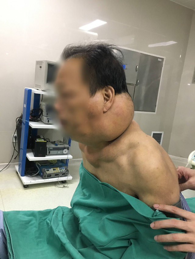 Biến thành... người khổng lồ sau nhiều năm nghiện rượu - Ảnh 1. Biến thành... người khổng lồ sau nhiều năm nghiện rượu - Ảnh 1.