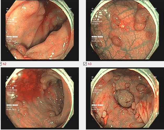 Cảnh báo bệnh nguy hiểm: Đa polyp trực tràng - Ảnh 1.