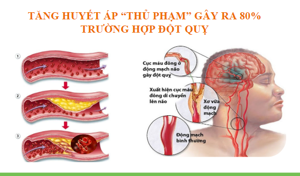 Xu hướng mới trong điều trị tăng huyết áp và phòng ngừa đột quỵ - Ảnh 1.