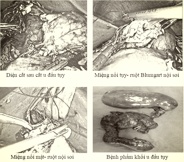 Phẫu thuật nội soi cắt khối t&aacute; tụy - Bước tiến mới trong điều trị ung thư v&ugrave;ng đầu tụy t&aacute; tr&agrave;ng - Ảnh 1.