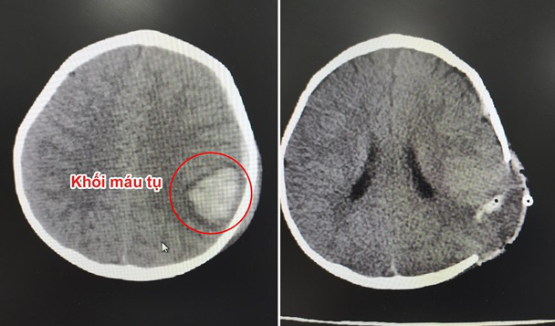 Trượt chân ngã, bé trai 11 tháng tuổi bị kéo đâm xuất huyết não - Ảnh 1.