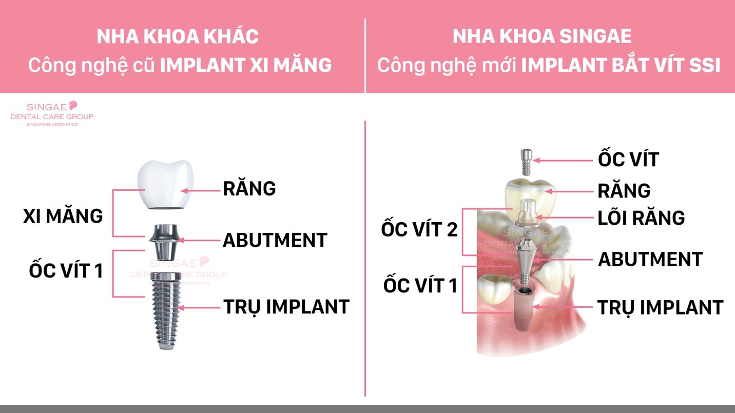 Nha khoa Singae – Địa chỉ uy tín để có hàm răng khỏe, đẹp - Ảnh 4. Nha khoa Singae – Địa chỉ uy tín để có hàm răng khỏe, đẹp - Ảnh 4.