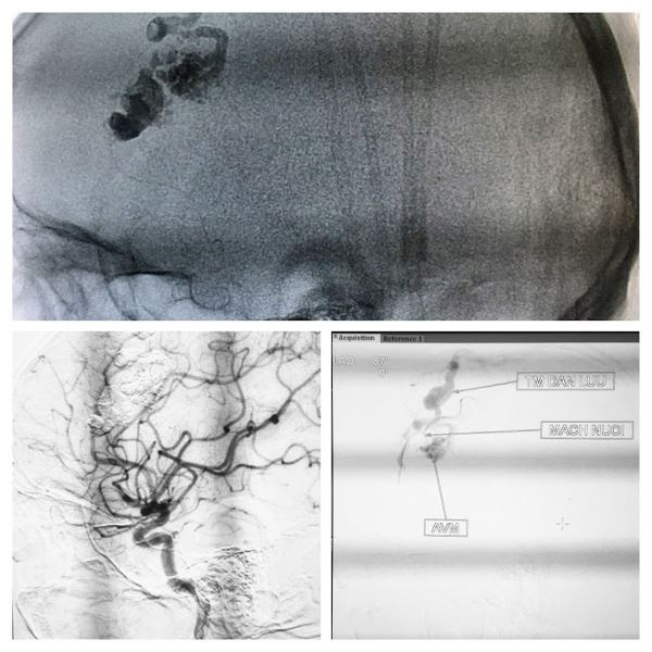 Cứu người đàn ông 32 tuổi bị vỡ thông động tĩnh mạch não - Ảnh 1.