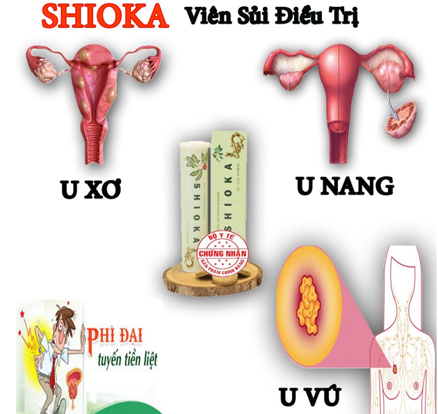 Viên sủi Shioka – tin vui cho chị em bị u xơ, u nang - Ảnh 3.