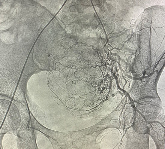Can thiệp nút mạch điều trị u xơ tử cung - Ảnh 1.