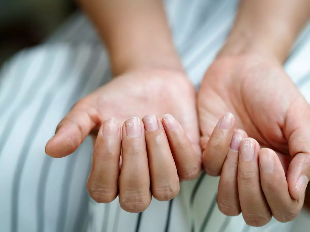 COVID-19: Triệu chứng đáng chú ý ở móng tay và chân - Ảnh 1. COVID-19: Triệu chứng đáng chú ý ở móng tay và chân - Ảnh 1.