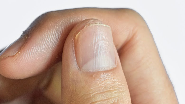 COVID-19: Triệu chứng đáng chú ý ở móng tay và chân - Ảnh 4. COVID-19: Triệu chứng đáng chú ý ở móng tay và chân - Ảnh 4.