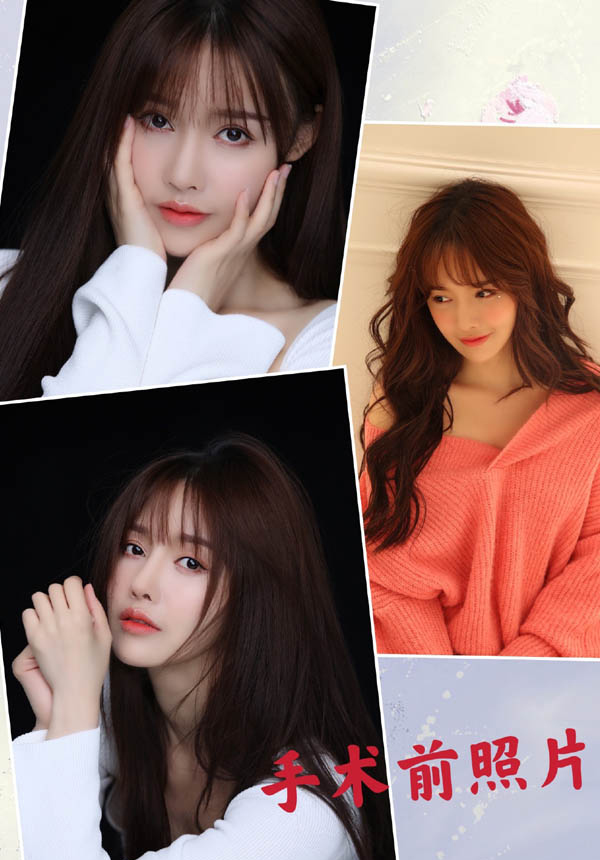 Nữ diễn vi&ecirc;n Trung Quốc bị hoại tử mũi do phẫu thuật khuy&ecirc;n c&aacute;c c&ocirc; g&aacute;i cẩn thận khi l&agrave;m đẹp - Ảnh 1.