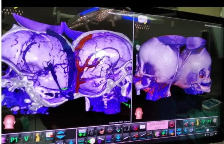 Israel tách thành công cặp song sinh dính liền đầu sau ca phẫu thuật kéo dài 12 giờ - Ảnh 2. Israel tách thành công cặp song sinh dính liền đầu sau ca phẫu thuật kéo dài 12 giờ - Ảnh 2.