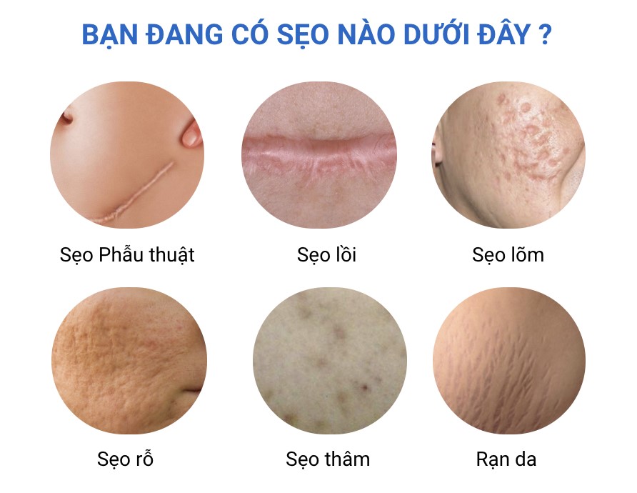 B&iacute; quyết xử l&yacute; th&acirc;m sẹo bằng Actiscar - Ảnh 1.