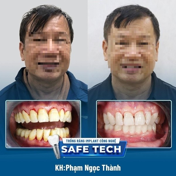 Safe-Tech: Công nghệ trồng răng Implant an toàn, không đau - Ảnh 3.