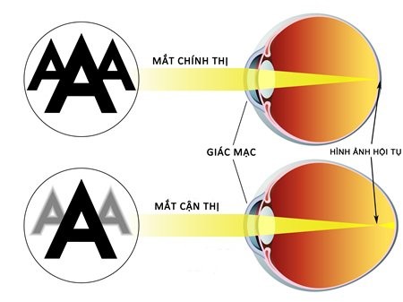 Cận thị: Bệnh lý hay xu hướng? - Ảnh 1.