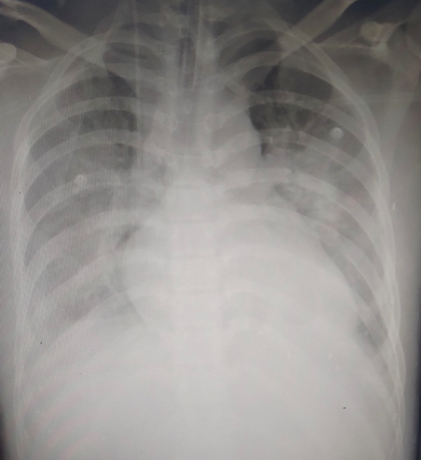 Đặt ECMO cứu bệnh nhân bị ngộ độc do uống 43 viên thuốc huyết áp - Ảnh 1. Đặt ECMO cứu bệnh nhân bị ngộ độc do uống 43 viên thuốc huyết áp - Ảnh 1.