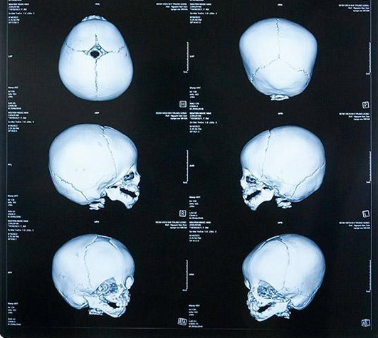 Thắp lên hy vọng cho bé gái 10 tháng tuổi mắc dị tật sọ mặt hiếm gặp - Ảnh 1.