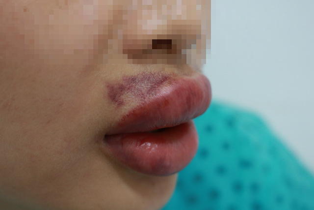 Môi sưng phồng, căng cứng, đau nhức sau tiêm filler - Ảnh 2. Môi sưng phồng, căng cứng, đau nhức sau tiêm filler - Ảnh 2.