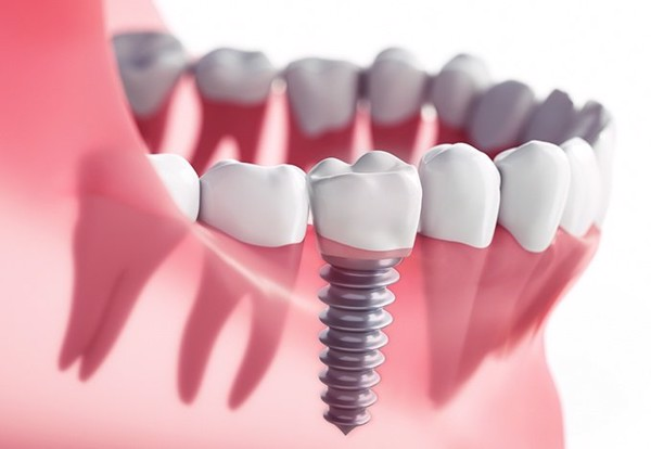 Trước khi thực hiện Implant cần lưu ý những vấn đề gì? - Ảnh 1.