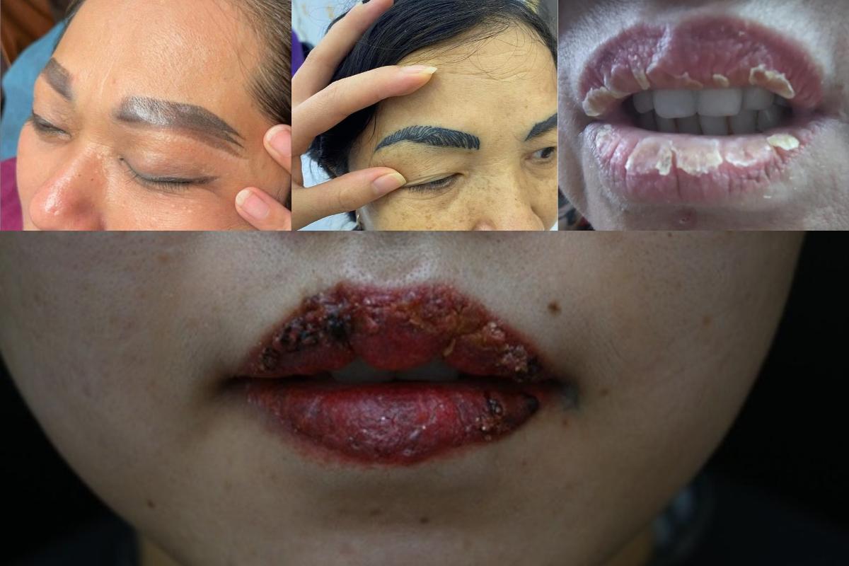 Hình ảnh minh họa biến chứng dị ứng và nhiễm trùng do xăm thẩm mỹ không an toàn