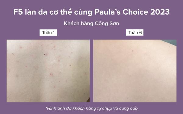 Mụn ở lưng: Nguyên nhân và cách điều trị - Ảnh 4.