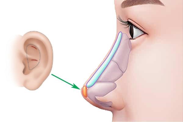 Sụn tự thân hay sụn nhân tạo sẽ cho dáng mũi bền đẹp tự nhiên? - Ảnh 3.