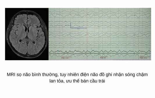 Người phụ nữ mắc viêm não tự miễn hiếm gặp - Ảnh 1.