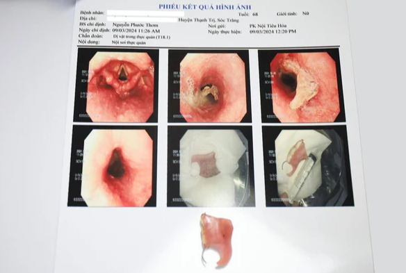 Kịp thời lấy hàm răng giả mắc kẹt trong thực quản bệnh nhân 68 tuổi ở Bạc Liêu - Ảnh 1.