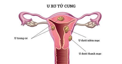  TPBVSK Tiêu Bách Khang giúp ức chế sự phát triển của u xơ tử cung như thế nào? - Ảnh 2.