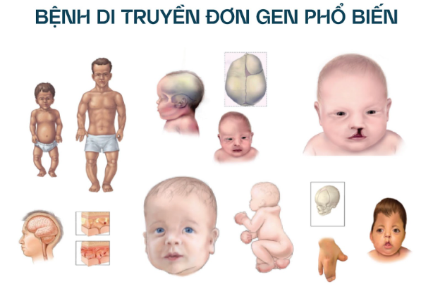 Sàng lọc trước sinh không xâm lấn mở rộng: Nên hay không nên? - Ảnh 1.