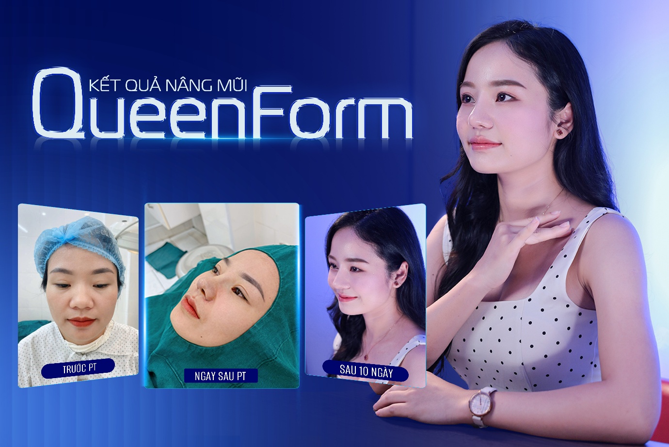 Ths.BS B&ugrave;i Văn Cường chia sẻ về sự thay đổi trong xu hướng n&acirc;ng mũi hiện đại- Ảnh 3.