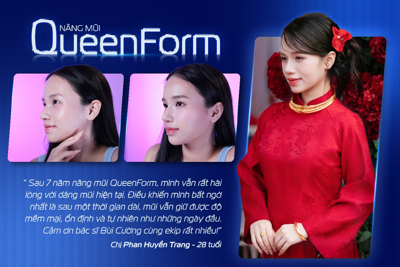 Ths.BS B&ugrave;i Văn Cường chia sẻ về sự thay đổi trong xu hướng n&acirc;ng mũi hiện đại- Ảnh 5.