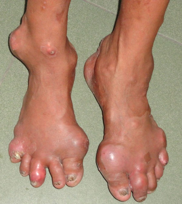 Triệu chứng của bệnh Gout nặng