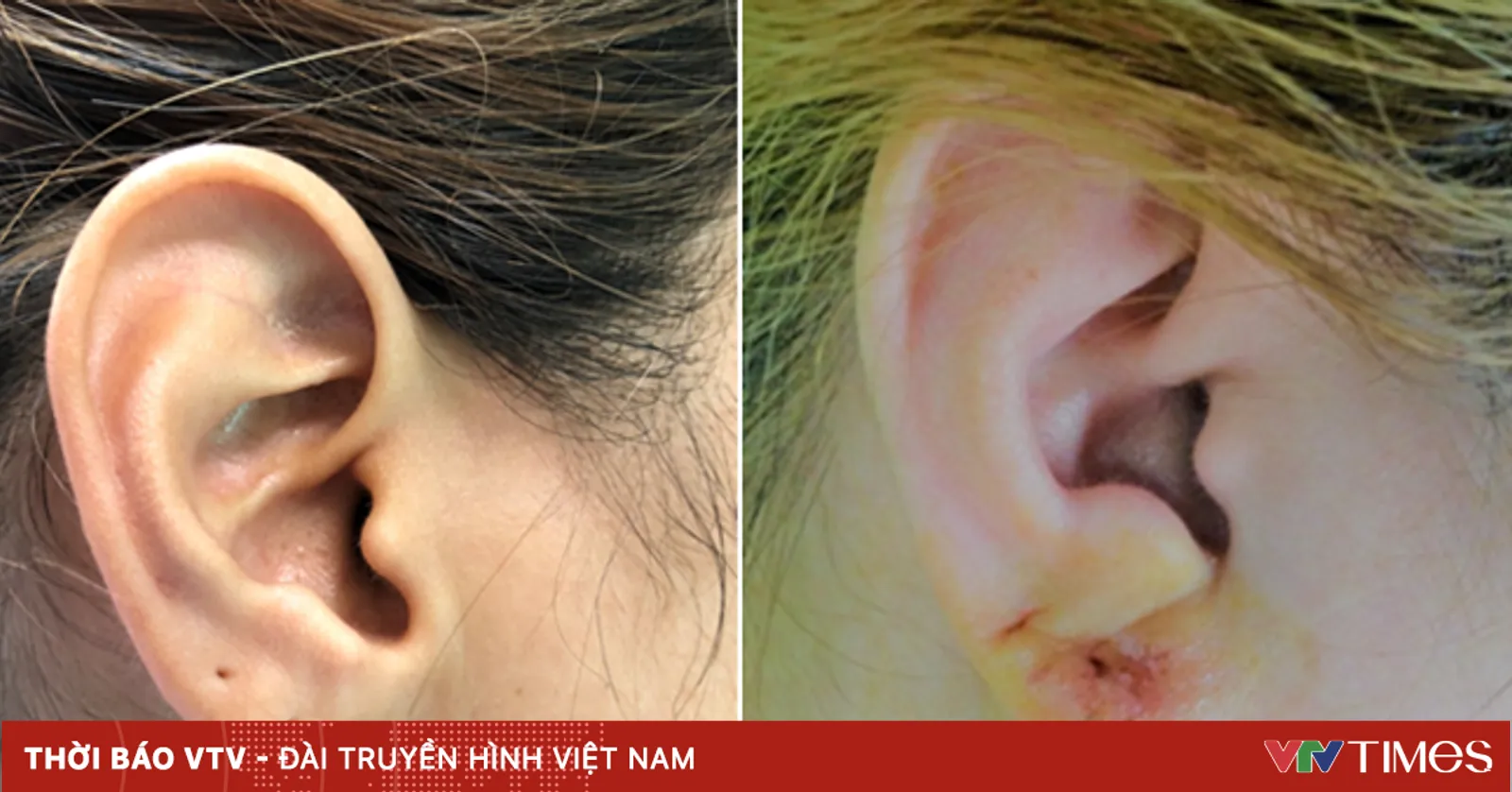 Rách dái tai và điều trị thẩm mỹ