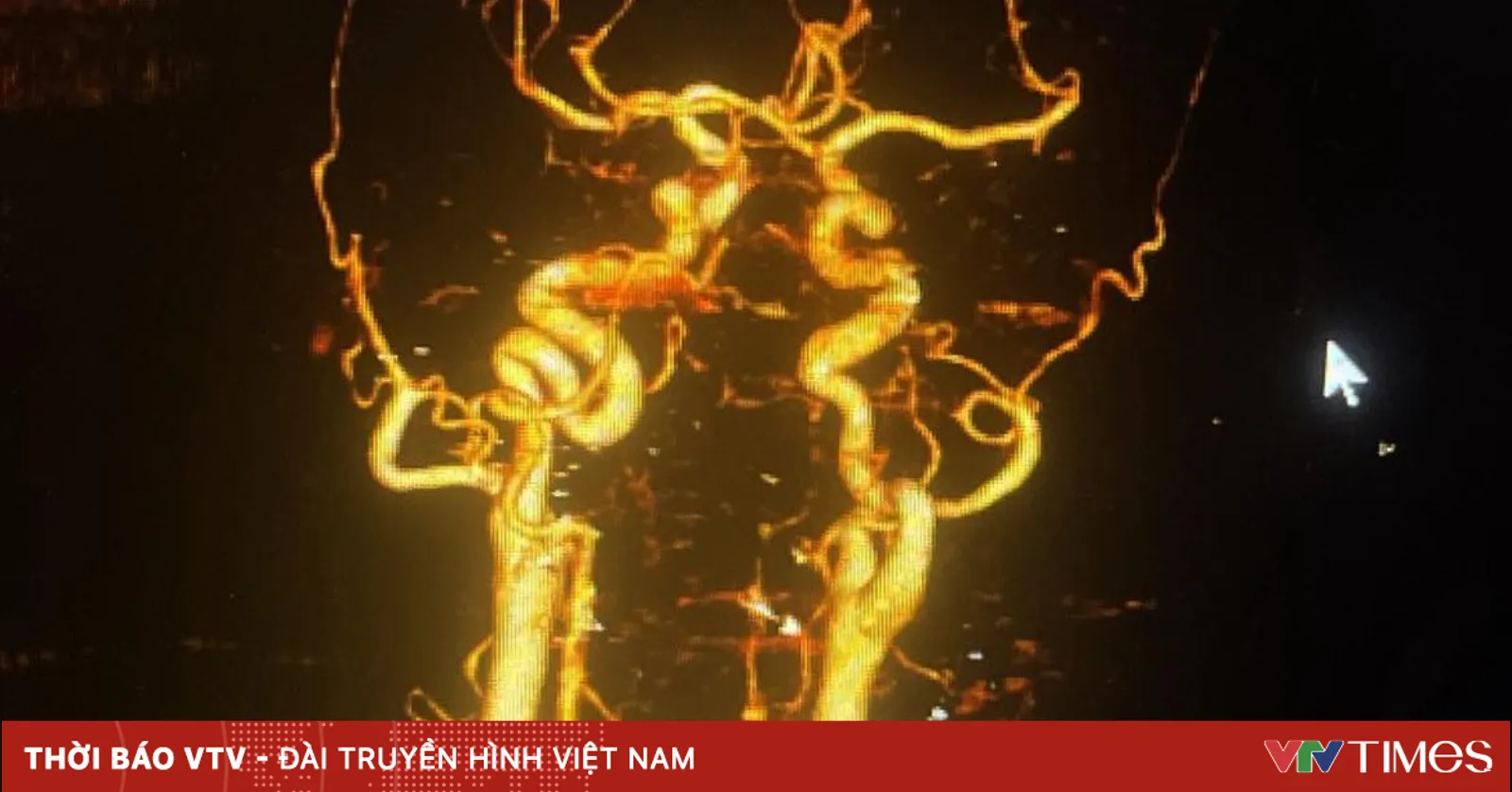 Bệnh nhân thoát khỏi tàn phế nhờ hiểu biết về đột quỵ